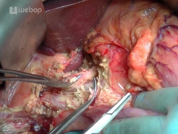 Dissecting the hepatoduodenal ligament