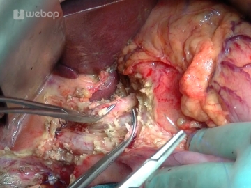 Dissecting the hepatoduodenal ligament