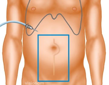 Establishing pneumoperitoneum and inspecting the abdominal cavity