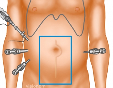 Trocar insertion