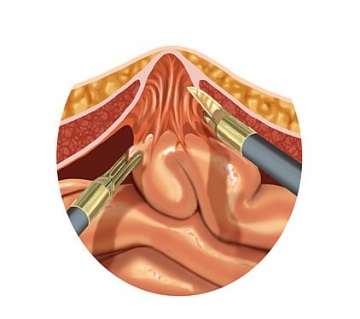 Adhesiolysis