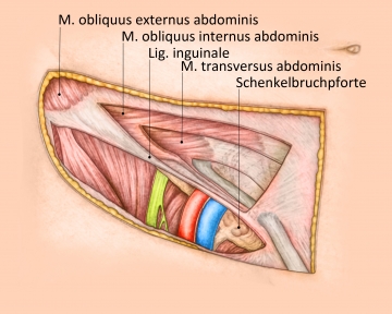 Anatomy - Femoral hernia repair – TIPP technique