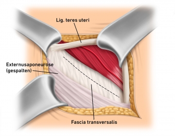 Splitting the aponeurosis of the external oblique and snaring the round ligament of uterus