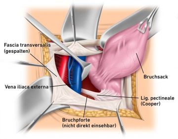 Anatomy - Femoral hernia repair – TIPP technique