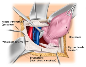 Splitting the transversalis fascia and exposing the hernial orifice