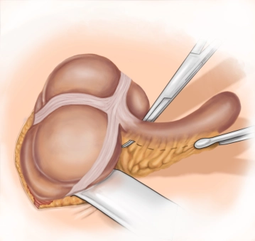 Skeletonization of the appendix