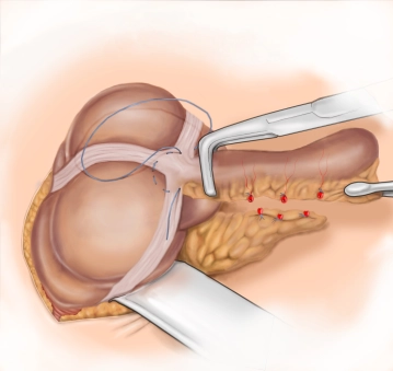 Placement of the purse-string suture