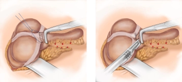 Ligation and resection of the appendix base