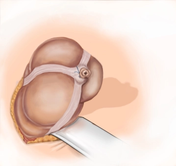 Inversion of the stump