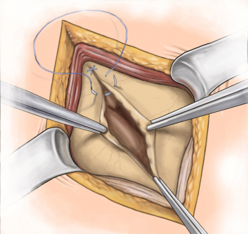 Peritoneal and fascial suture
