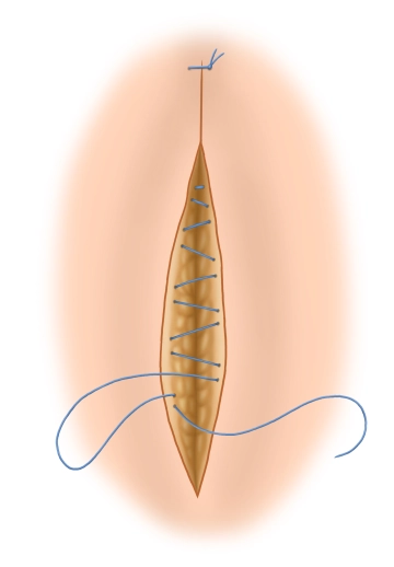 Ending the operation