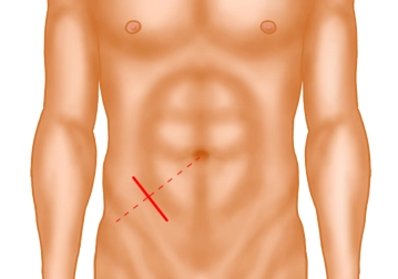 Skin incision