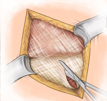 Splitting the external aponeurosis