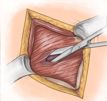 Splitting the abominal muscles