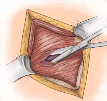 Splitting of the muscle