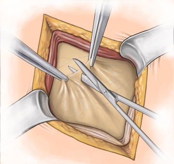 Peritoneal incision