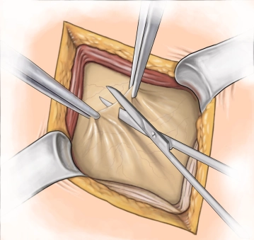 Peritoneal incision