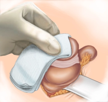 Luxation of the cecal pole