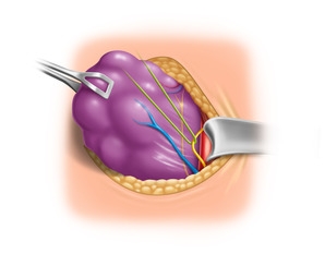 Darstellung, Anzügeln und Neuromonitoring des N. vagus