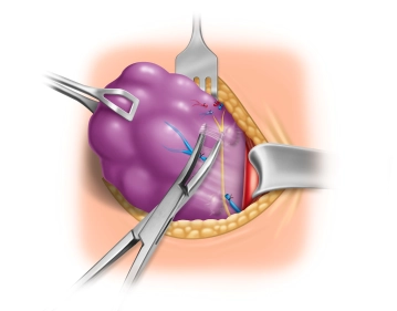Visualization of the Upper Parathyroid Gland