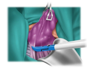 Mobilization and Extirpation of the Thyroid Lobe