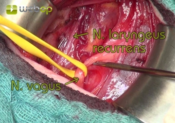 Final Neuromonitoring of the Recurrent Laryngeal Nerve and Vagus Nerve