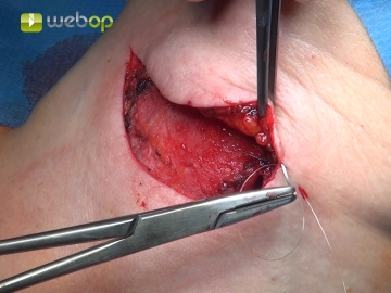 Layered Wound Closure