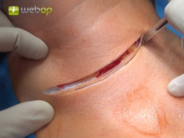 Skin Incision/Scar Excision