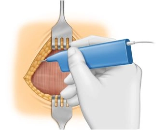 Mobilization of Wound Edges