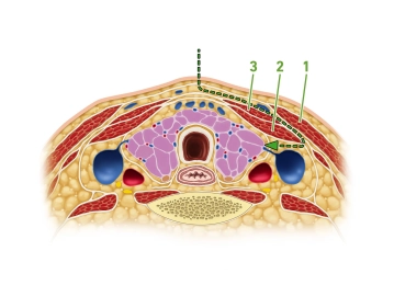 Entering the Thyroid Bed at the Anterior Edge of the Sternocleidomastoid Muscle