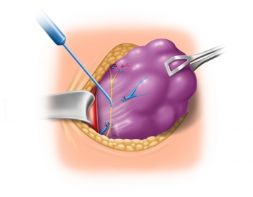 Mobilizing the inferior parathyroids and exposing the recurrent laryngeal nerve