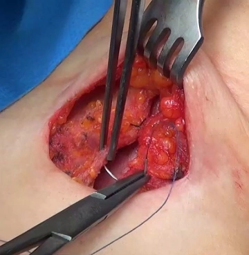 Wound closure