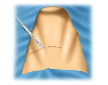 Skin Incision