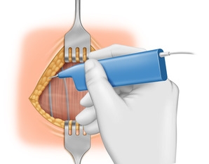 Mobilizing the wound edges