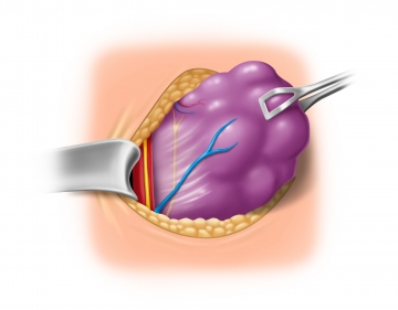 Exposing and neuromonitoring the vagus nerve