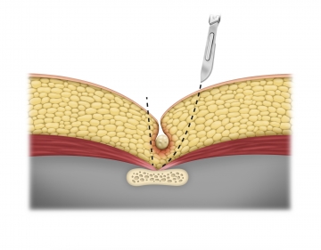 En-bloc excision