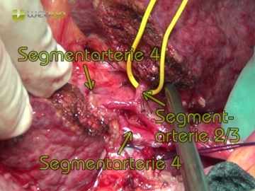 Dissecting the segmental hila, ligating the segmental artery II/III