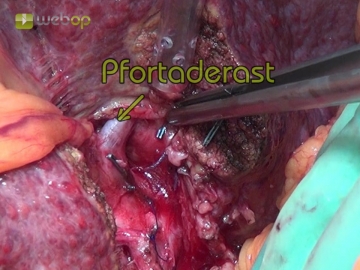Left Lateral Liver Resection Open