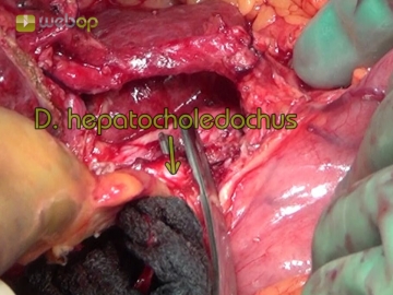 Left Lateral Liver Resection Open