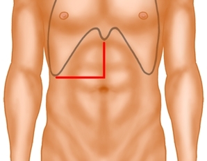 Laparotomy and exploration of the abdominal cavity