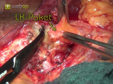 Dissecting the hepatoduodenal ligament and lymph nodes