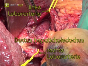 Hilar dissection