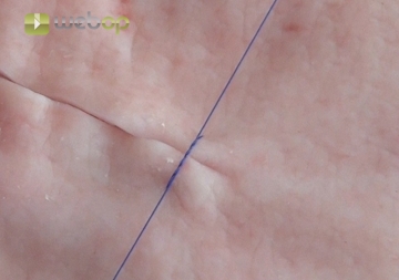 Interrupted sutures and instrument ties