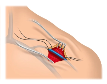 Preparación de la V. cefálica en el surco deltopectoral