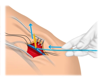 Introducción y colocación correcta de la sonda del desfibrilador con la ayuda de un «zapato»