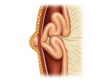 Aspectos anatómico-clínicos del cierre de incisiones de trocares