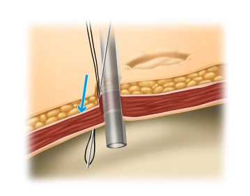 Introducción del hilo
