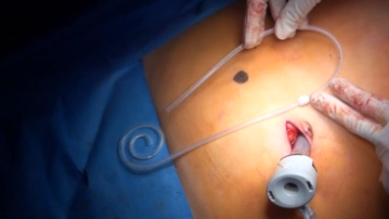 Special instruments and fixation systems