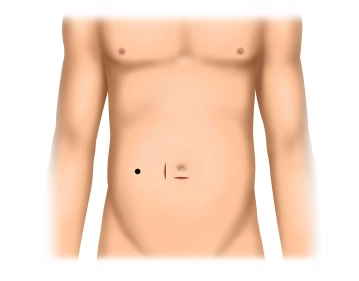 Infraumbilical access