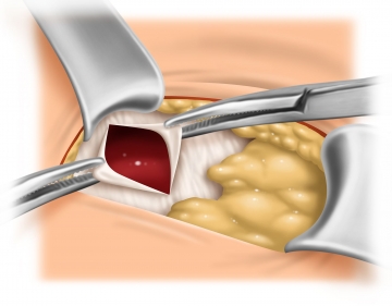 Exposure of the umbilical orifice